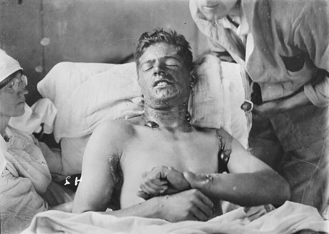 Soldato canadese con ustioni e vesciche causate dall'iprite (ca. 1917-18)